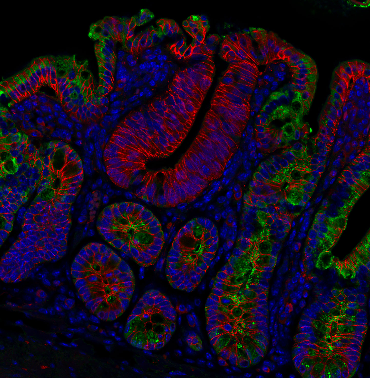 New Insights Into Immune Interactions And Bowel Cancers Loss Of APC 